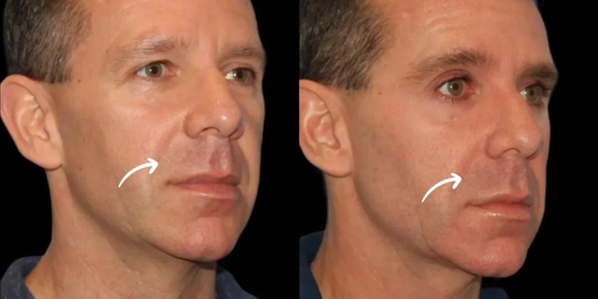 Best Doctors in Dubai Share Sculptra for Weak Chin Correction