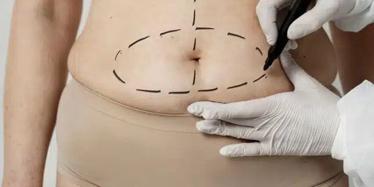 How Much Does a Tummy Tuck in Dubai Cost in 2026?