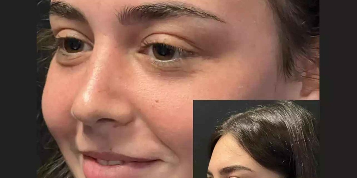 Rhinoplasty in Dubai: Expert Insights for Better Decisions