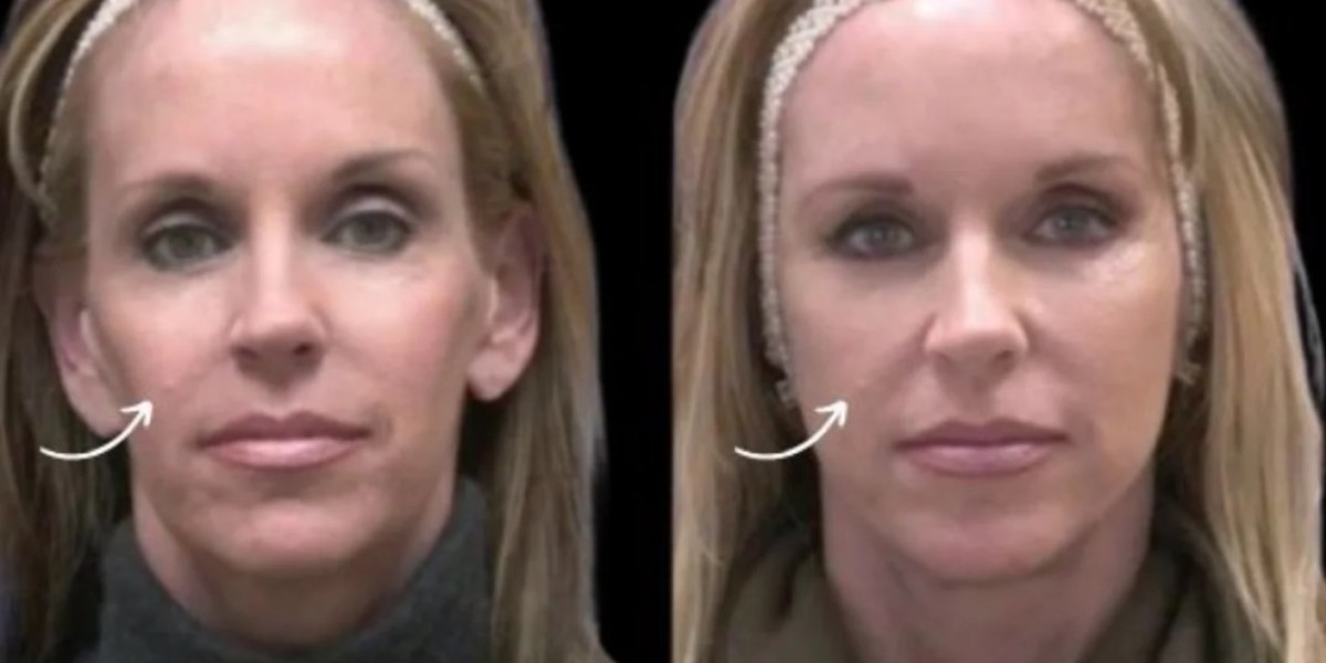 Best Doctors in Dubai Discuss Sculptra for Slim Profiles