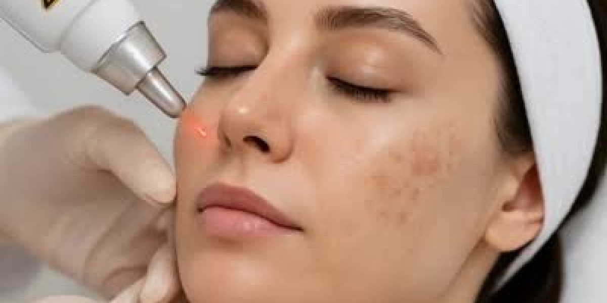 Laser For Pigmentation In London: Restore Even Skin Tone Naturally