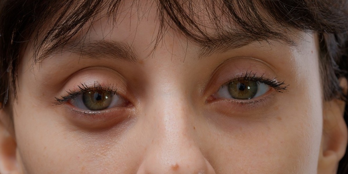 Eyelid Bag Surgery Dubai: How the Procedure Restores a Refreshed Appearance