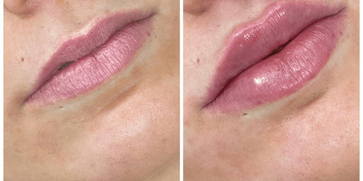 Best Plastic Surgeon in dubai for Juvederm