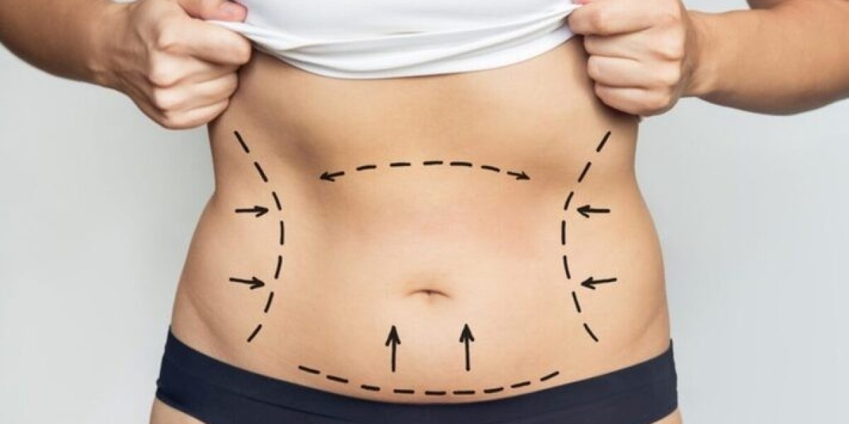 Liposuction in Dubai Designed for Your Unique Body Goals