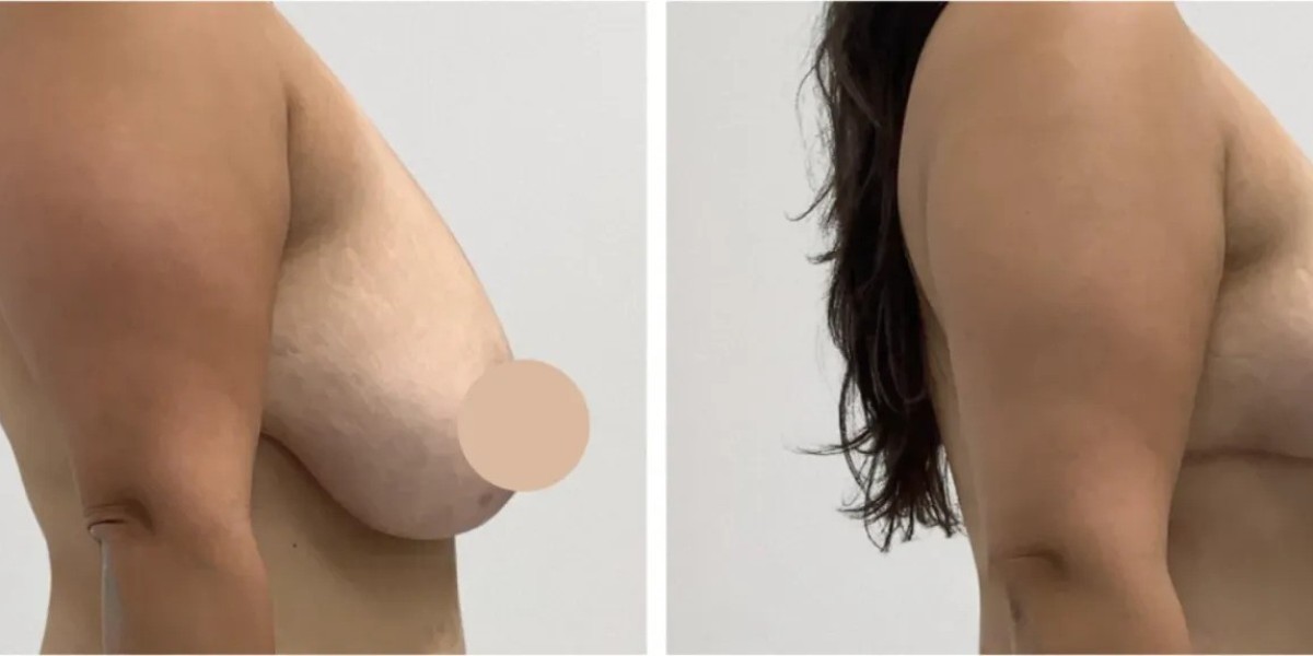 Best Breast Lift Surgeons in Dubai for Expert Surgical Excellence