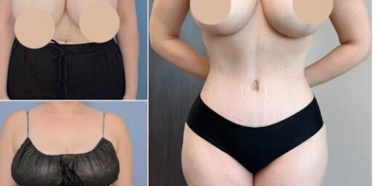 Tummy Tuck in Dubai for a More Refined Body Shape