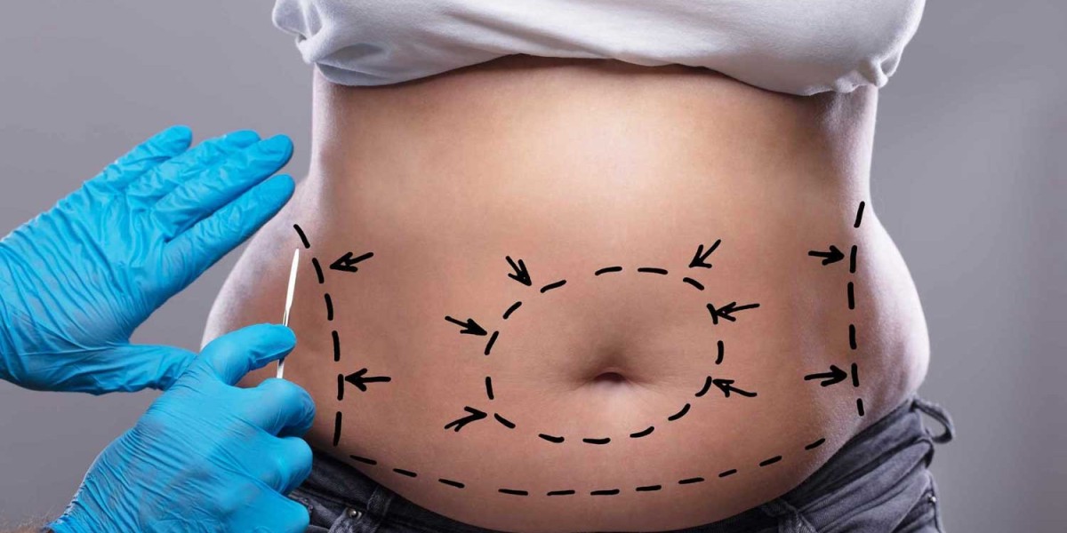 Tummy Tuck Dubai: How to Reduce Scarring After Surgery