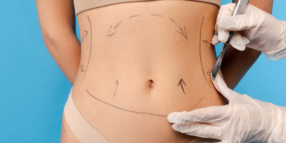 Liposuction in Dubai: How It Helps Reshape Stubborn Fat Areas