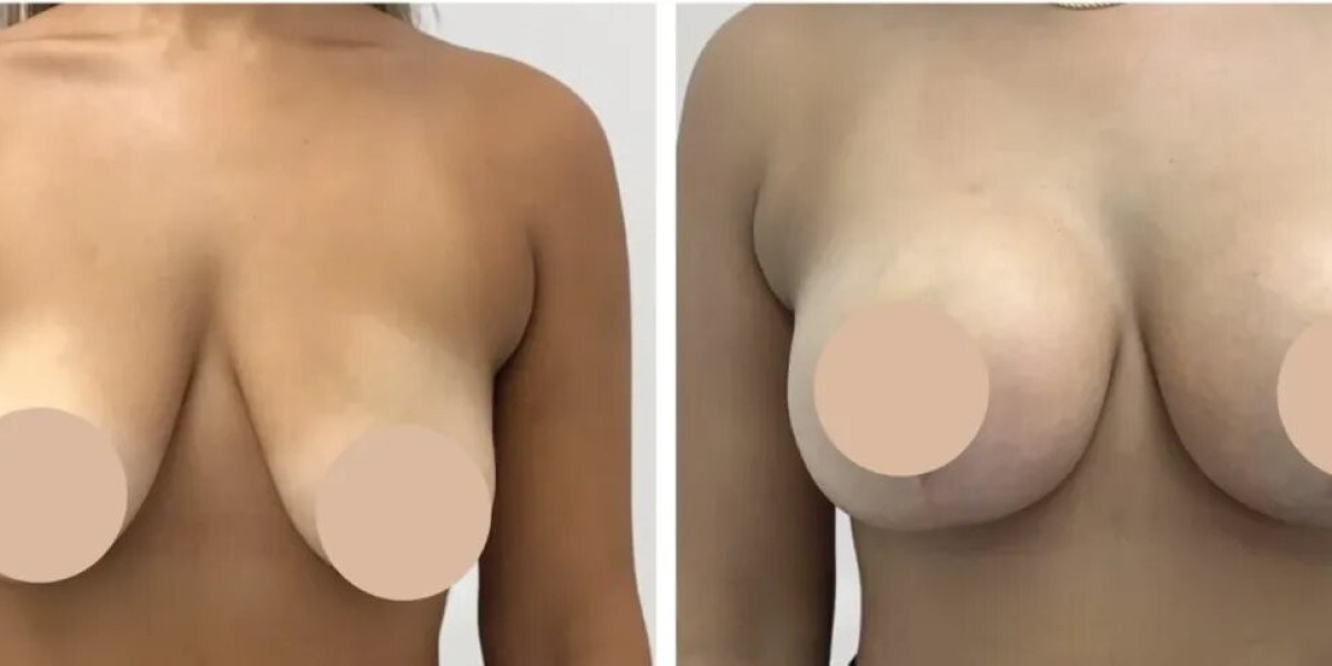 Best Breast Reduction Surgeons in Dubai for Customized Cosmetic Solutions