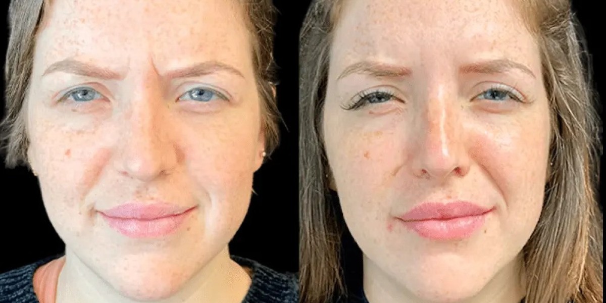 Best Doctors in Dubai for Botox: Find Trusted Aesthetic Specialist