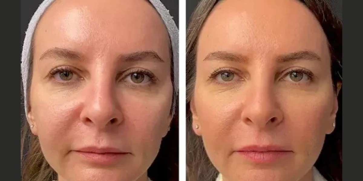 Best Aesthetic Clinics in Dubai for Mesotherapy: How Much Does Cost?