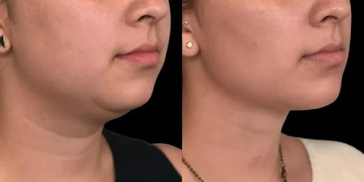 Best Double chin removal Surgeon in dubai Help!
