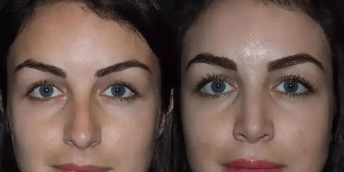 Rhinoplasty in Dubai: How to Plan Your Cosmetic Nose Surgery