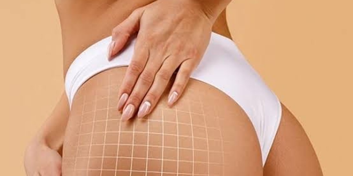 Butt Fillers in Dubai: Achieve Balanced Body Contours Naturally