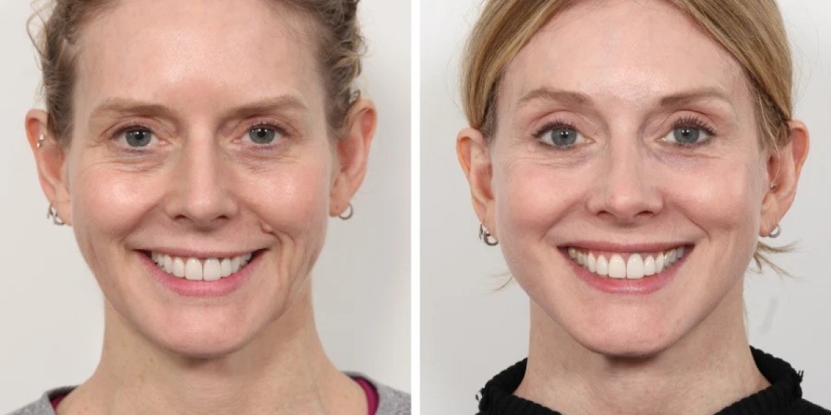 Best Aesthetic Clinics in Dubai for Natural Thread Lift Results
