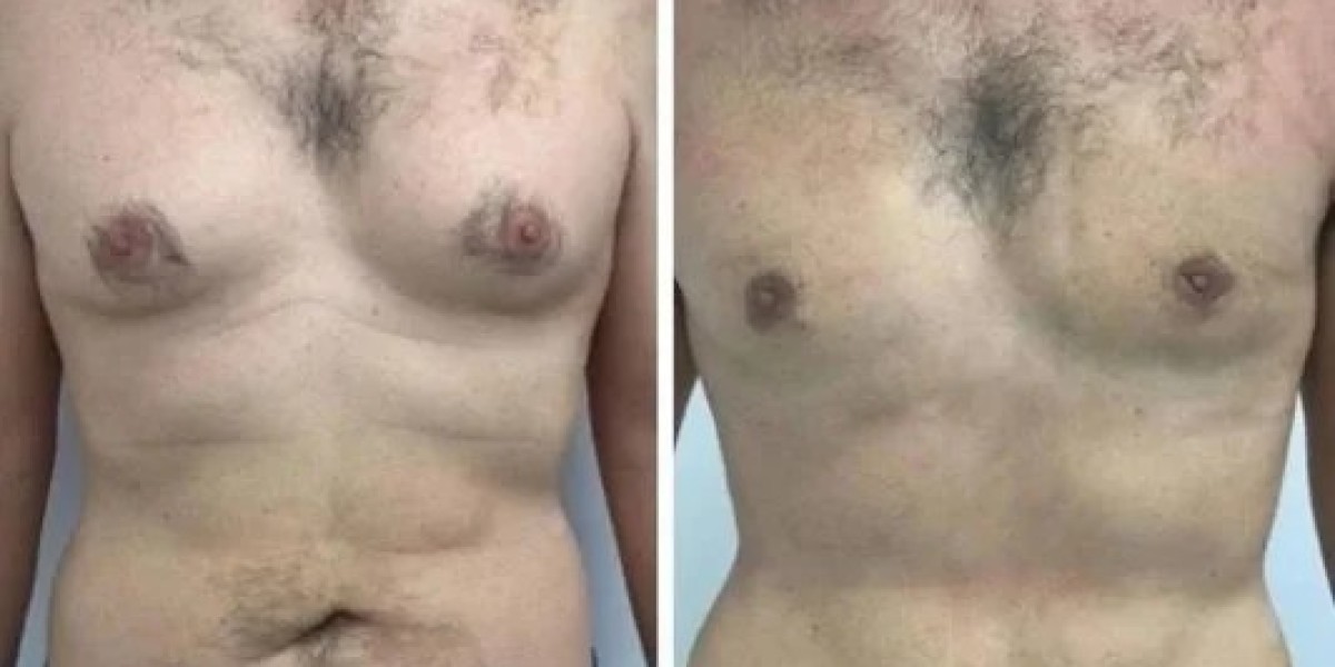 Gynecomastia Surgery in Dubai: What You Need to Know About Recovery