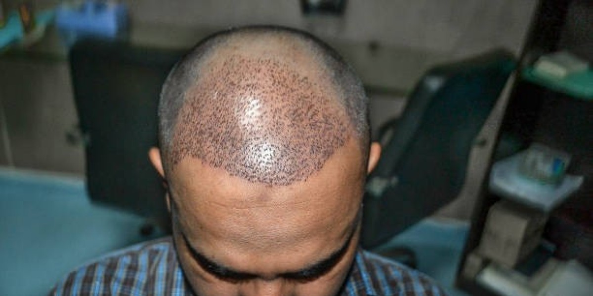 Hair Transplant For Curly Hair: Special Considerations Explained