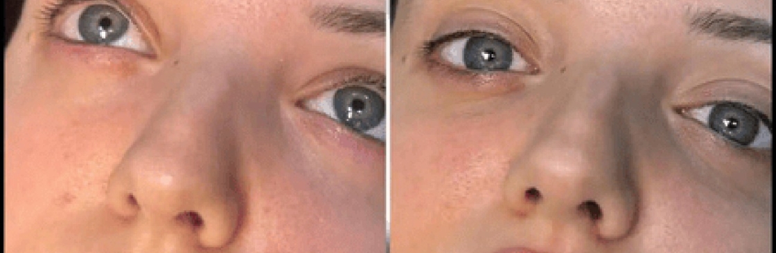 dermal fillers Cover Image