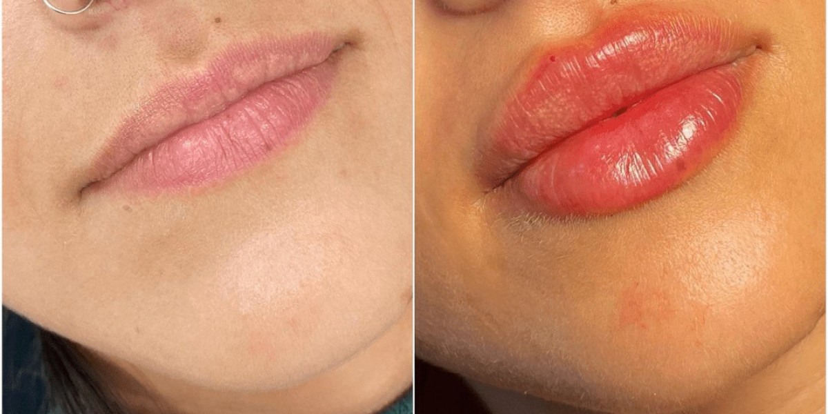 Juvederm Treatments in Dubai for Younger Appearance