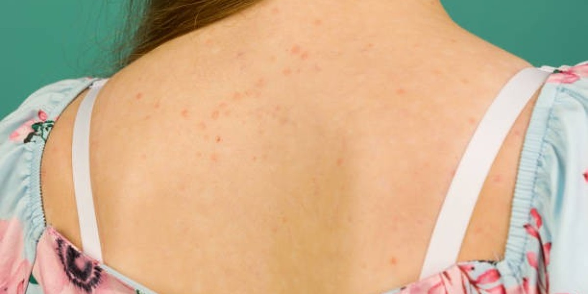 How to Treat Back Acne With Retinoid Gel Guidance