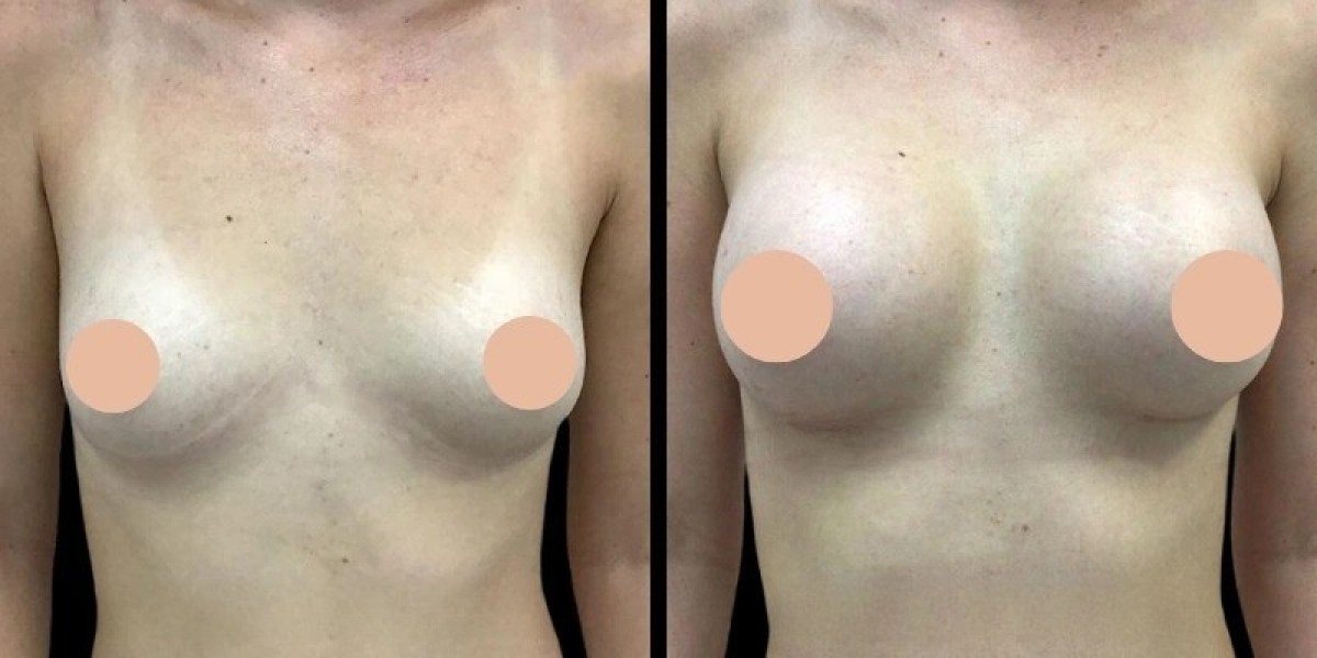 Breast Augmentation in Dubai: Scars, Healing, and Aftercare