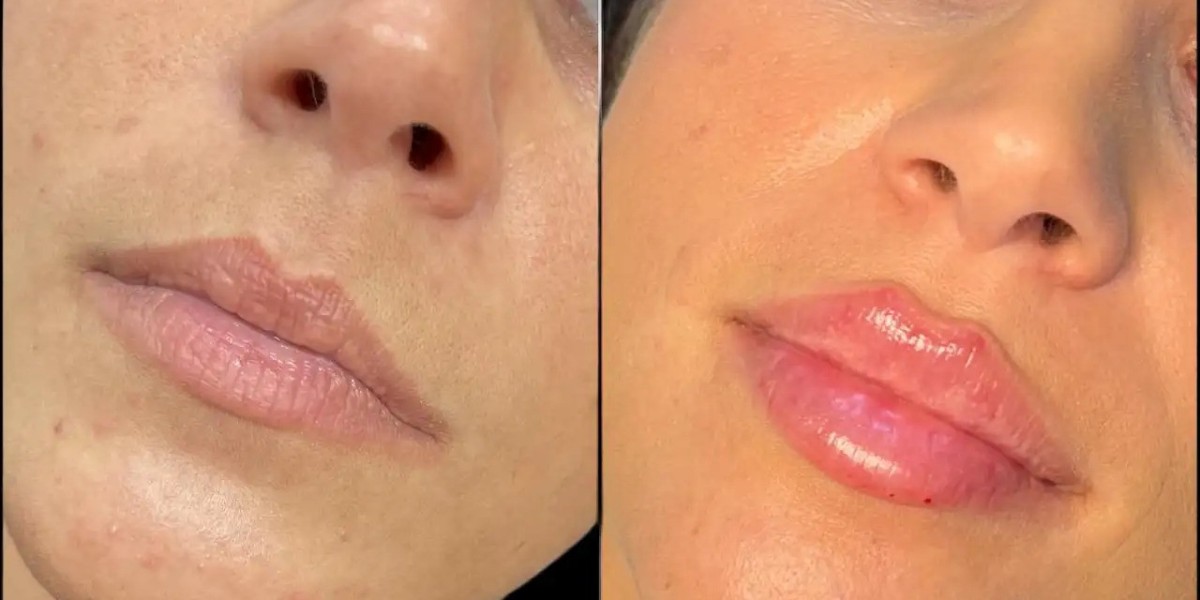Best Aesthetic Clinics in dubai for Advanced Fillers Treatments
