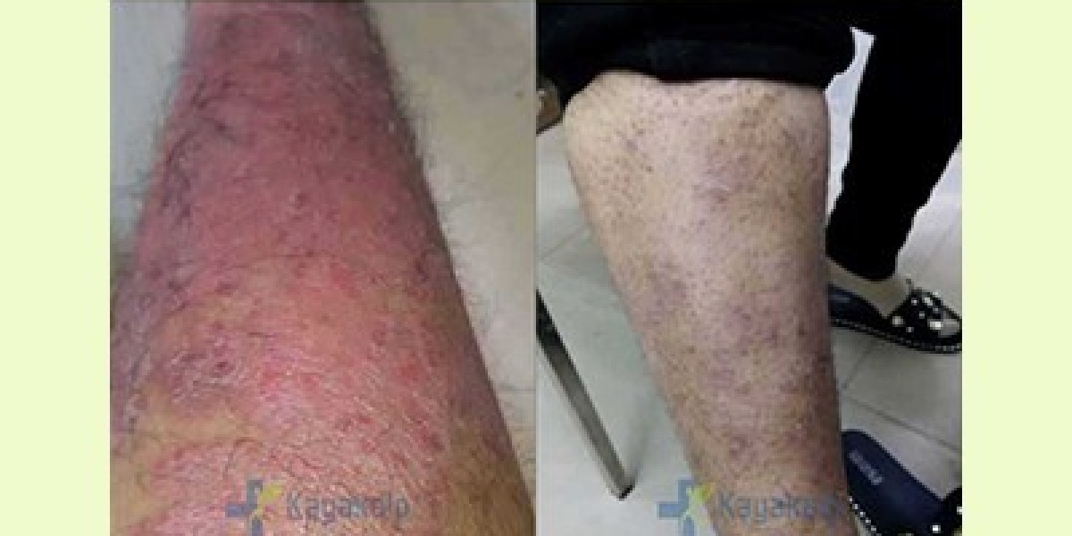 Vitiligo Treatment in India and Psoriasis Treatment in India