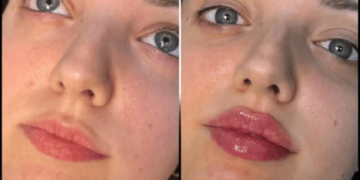 Best Doctors in dubai for Fillers: Delivering Natural and Balanced Results
