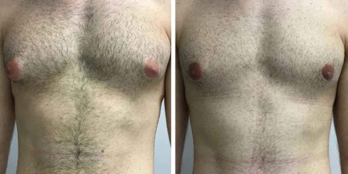 How Recovery Progress Is Monitored After Gynecomastia Surgery in dubai