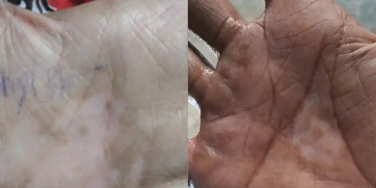 Vitiligo Treatment Patna: Understanding Treatment Options