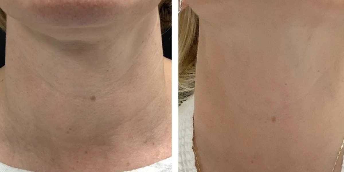 Radiofrequency (RF) Microneedling treatments in Dubai for Pore Refinement