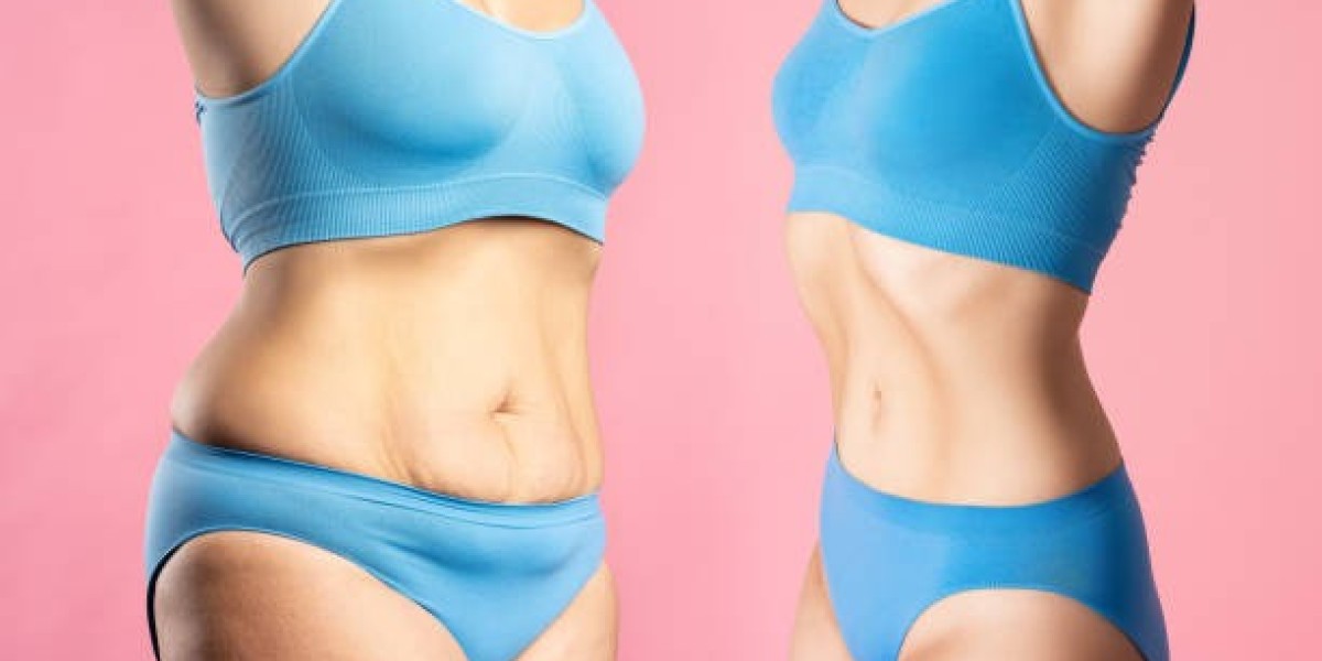 How Tummy Tuck Surgery in Riyadh Removes Excess Abdominal Skin Safely