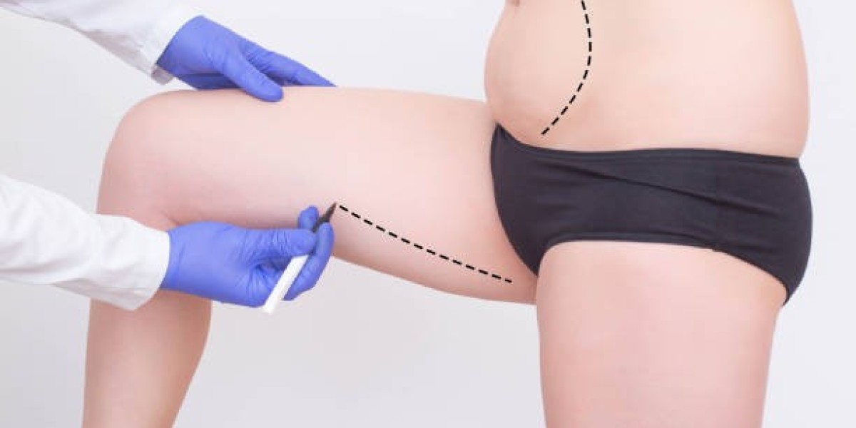 Liposuction in Riyadh: A Guide to Modern Fat Reduction Procedures