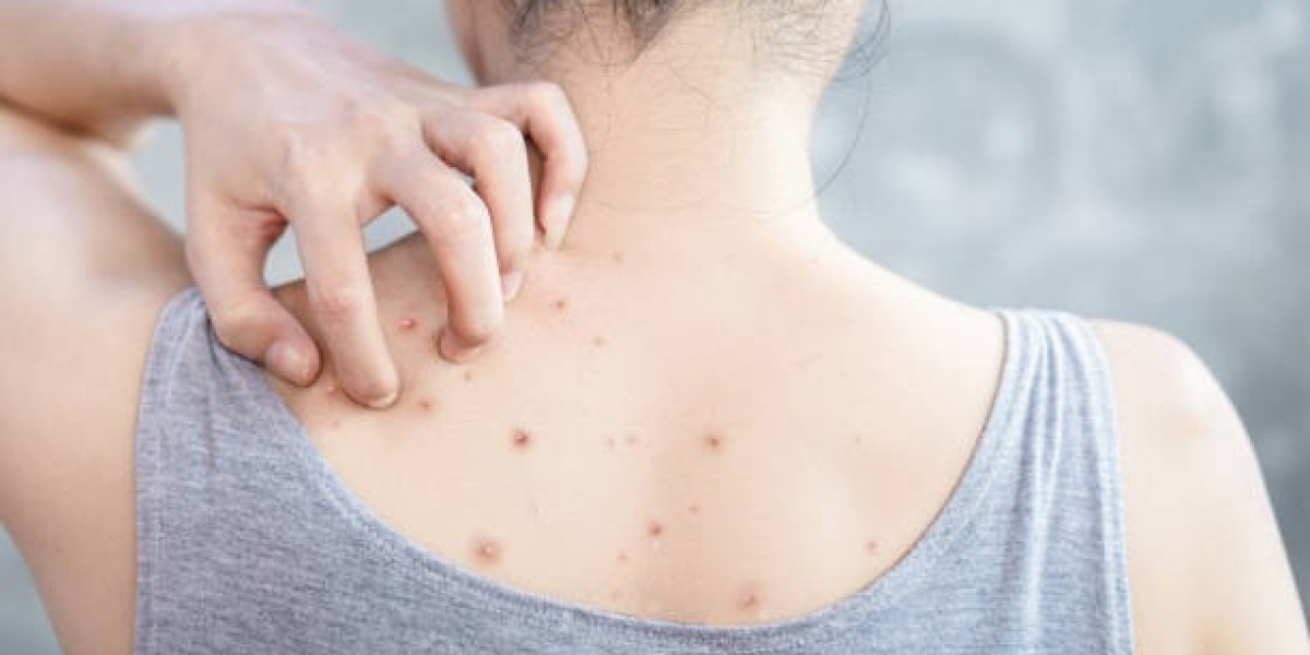 Understanding Back Acne: Effective Treatments for Healthier Skin
