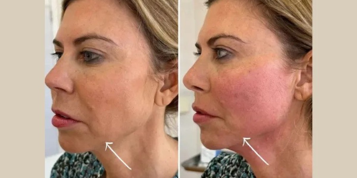 Endolift Treatment in Dubai for Refined Chin Definition Solutions