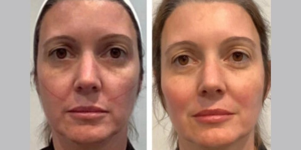 Best Aesthetic Clinics in Dubai for Thread Lift and Anti-Aging Treatment
