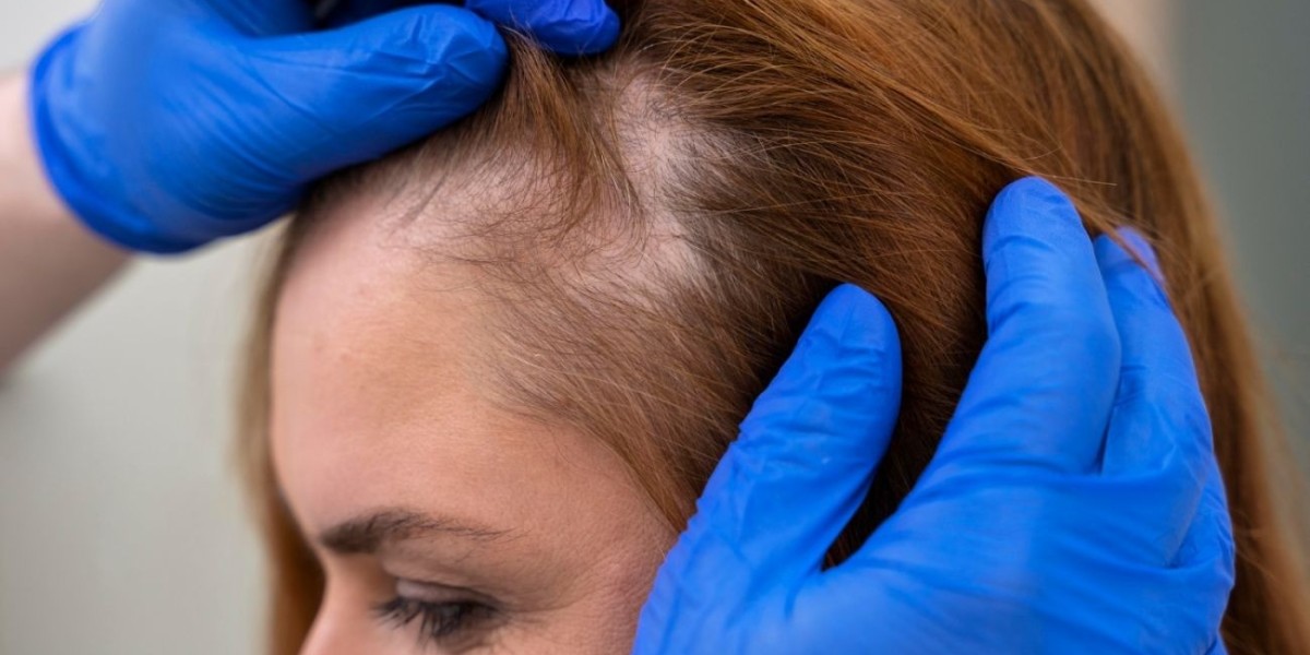 Address Hair Thinning With Female Hair Transplant in Dubai